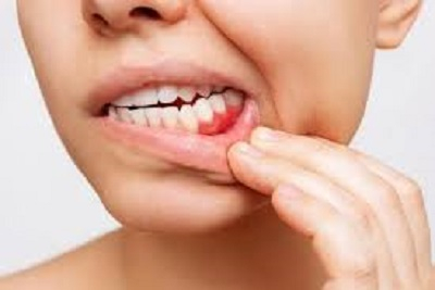 Preventivni tretmani gingivalnih dzepova po vilici.Akcija